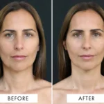Face Lift Massage