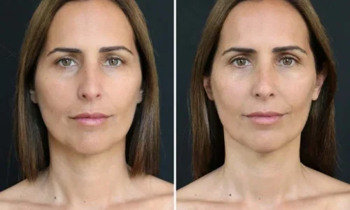 Discover the Secret of How to Do a Face Lift Massage for a Rejuvenated Look