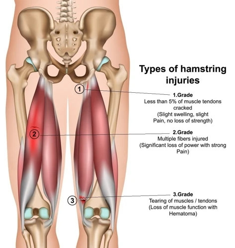 Causes Of Hamstring Strains