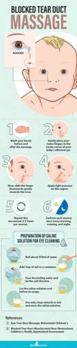 How To Massage A Blocked Tear Duct In Babies