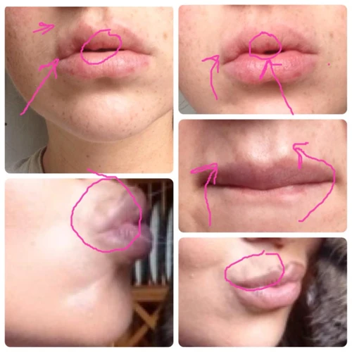 How To Massage Lip Fillers At Home