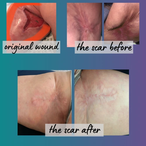 How To Massage Scar Tissue After Surgery