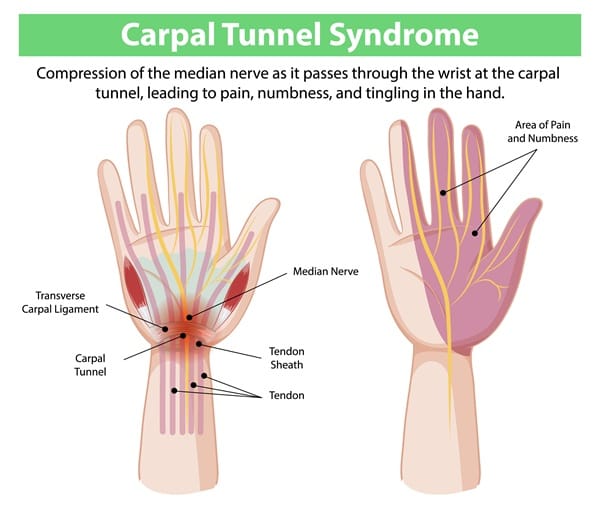 Symptoms of Carpal Tunnel Syndrome Symptoms of Carpal Tunnel Syndrome