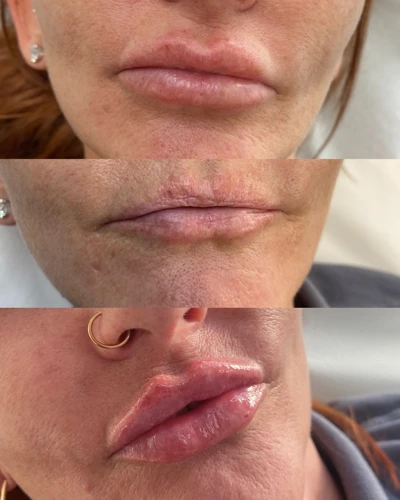 Step-By-Step Guide To Massage Migrated Lip Filler