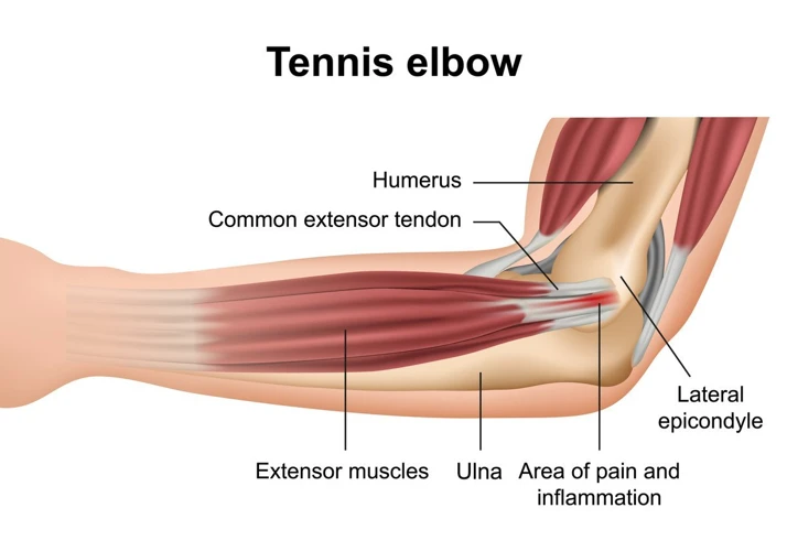 Symptoms Of Tennis Elbow