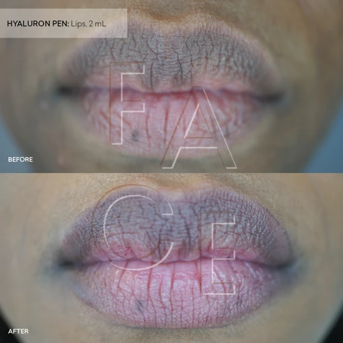 What Are The Benefits Of Massaging Lip Fillers?