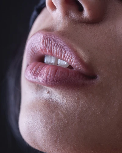 What Is Migrated Lip Filler?