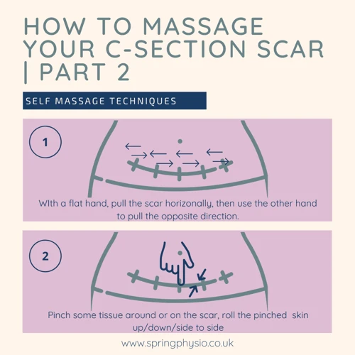 When To Start C-Section Scar Massage?