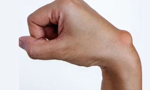 How to Massage a Ganglion Cyst for Pain Relief & Healing
