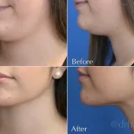 Massage After Chin Lipo