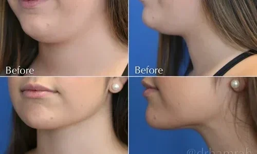 How to Reap Maximum Benefits from Massage After Chin Lipo