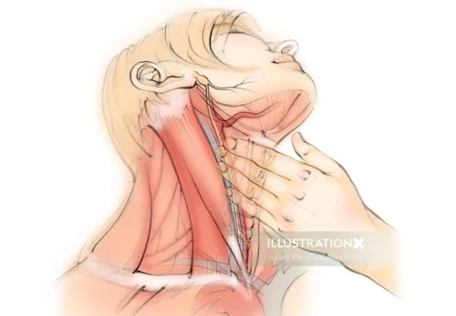 How to Perform Carotid Massage