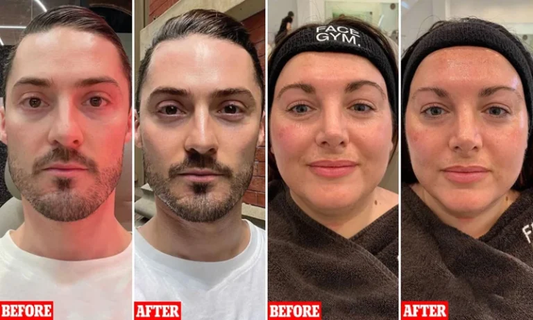 Techniques For Jawline Massage