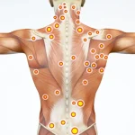 Trigger Point Therapy