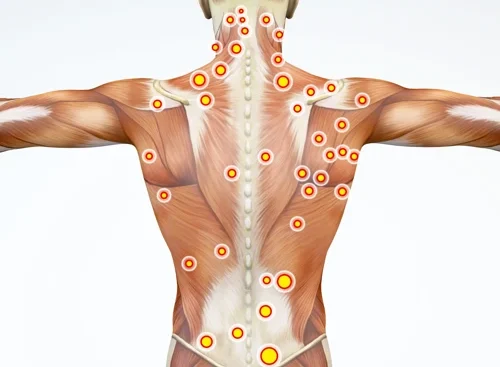 Trigger Point Therapy