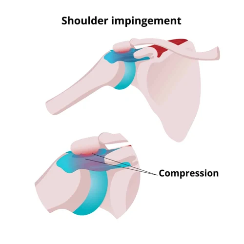 What Is An Impingement?