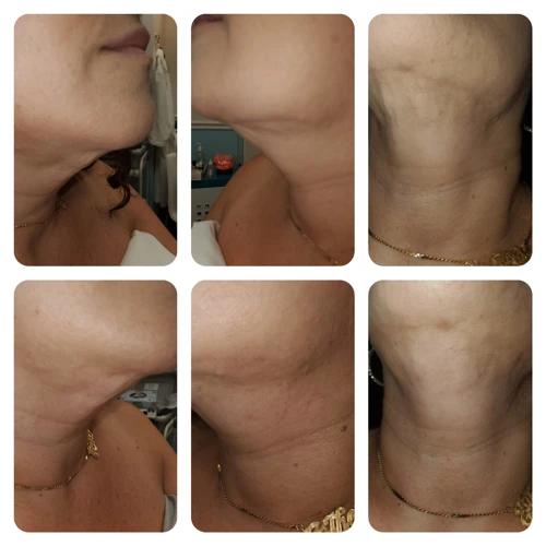 What Is Chin Lipo?