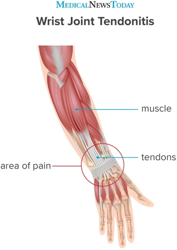 What Is Wrist Tendonitis?
