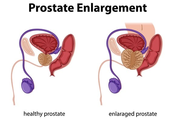 What Is Prostatitis Inside the male reproductive system