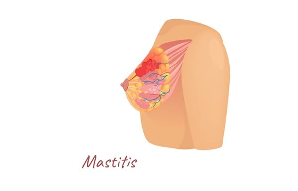 Mastitis Therapy