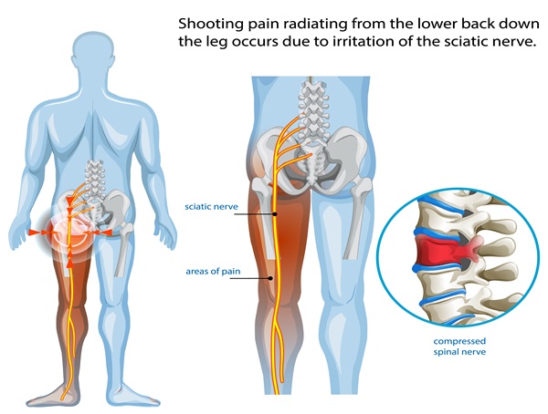 Massage for Sciatica