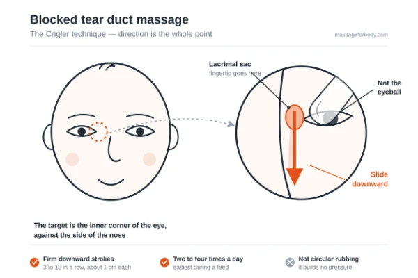 Diagram of an infant face with a magnified view of the inner eye corner, showing fingertip position over the lacrimal sac and a downward stroke arrow along the side of the nose